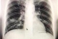 Đặc điểm hình ảnh XQuang Viêm phổi do Corona Virus